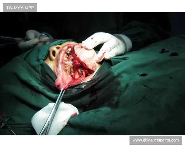 独立格斗选手史密斯伤势严重，颚骨骨折及多颗牙齿脱落